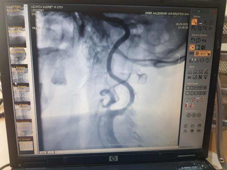 Niğde’de damar rahatsızlığı olan hastanın boynuna stent takıldı